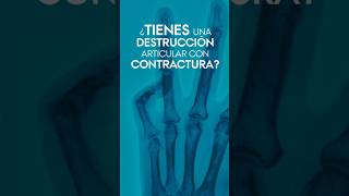 ¿Sufres una destrucción articular con contractura Mira el resultado de la Artrodesis Interfalángica