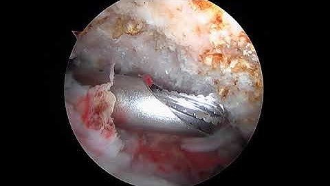 R Shoulder Rotator Cuff Repair and Biceps Tenodesis 9.14.20