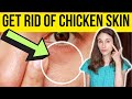 HOW TO GET RID OF CHICKEN SKIN UNDER EYES | Dermatologist