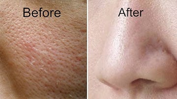 Get Rid of Large Pores in 3 Days | Get Smooth, Fairer and Tighter Skin