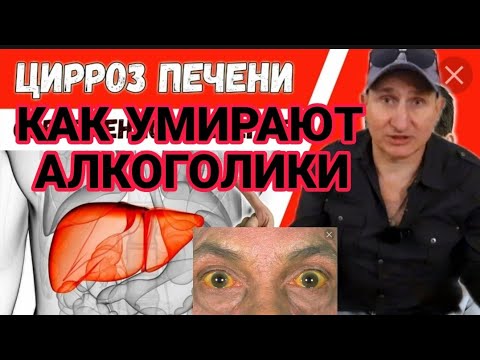 КАК УМИРАЛ ОТ ЦИРРОЗА ПЕЧЕНИ МОЙ ДРУГ /ПЕРВЫЕ ПРИЗНАКИ ЦИРРОЗА И СКОЛЬКО ЖИВУТ ПРИ ЦИРРОЗЕ ПЕЧЕНИ