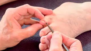 Deep little toe massage using chopsticks and other tools to relieve hip pain. Part 1