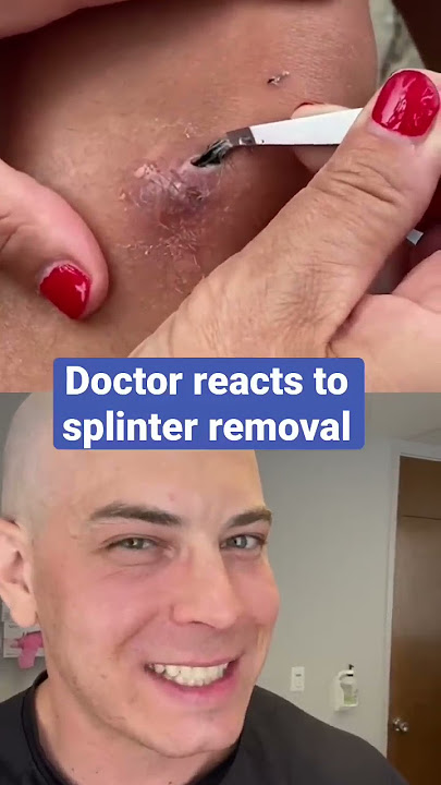 Doctor reacts to splinter removal!