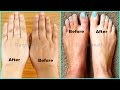 100% EFFECTIVE Hands & Feet Whitening Remedy ( With LIVE Demo )