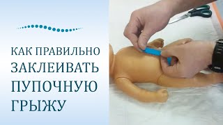 Надо ли заклеивать пупочную грыжу? 30 апреля 2020 г.