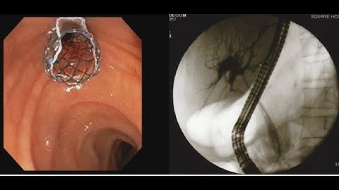 Cholangiocarcinoma ERCP Metallic Stent Placement #BD_ENDOSCOPY
