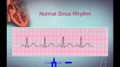 Introduction to EKG Rhythm Interpretation (Part 1)