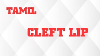 CLEFT LIP IN TAMIL/INTRODUCTION/CAUSES/TYPES/CLINICAL FEATURES/TREATMENT