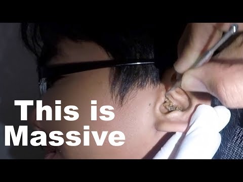 Removing Teenage Boy&39;s Earwax with Hydrogen Peroxide