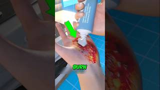 Burned Yourself? Don’t Use Ice Do This Instead!