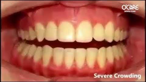 Cận cảnh răng dịch chuyển khi Niềng Răng