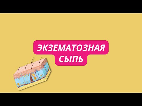 Экзематозная сыпь (экзема, дерматиты) что это, лечение