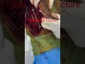 accident read ki haddi Tut Gai thi    . surgery week