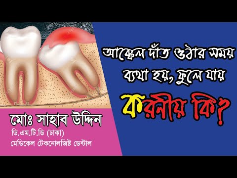 আক্কেল দাঁত ওঠার সময় ব্যথা হয়,ফুলে যায় করনীয় কি? How to prevent wisdom t...