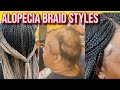 Have you seen these new alopecia hairstyles you can wear