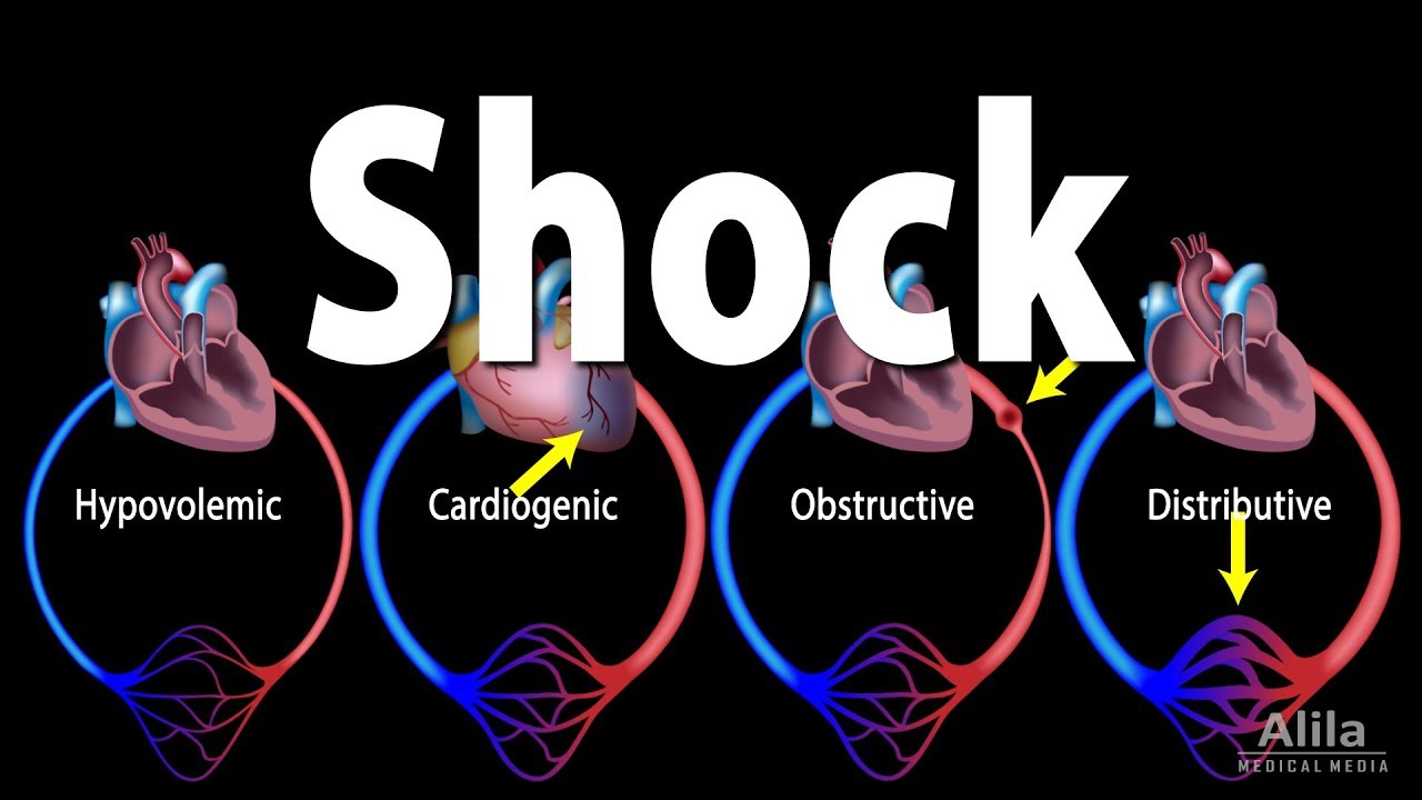 Shock Pathology of Different Types Animation