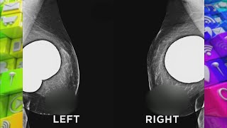 The Breast Implant Changes You Should Be Concerned About