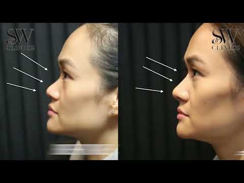 Shyrel's DRSW Clinics Non-Surgical Rhinoplasty w/ Filler Review | Dr Sherif Wakil