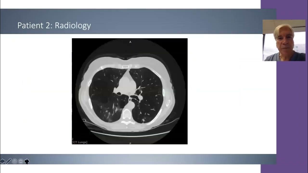 Selecting Patients for Zephyr Endobronchial Valve Treatment YouTube