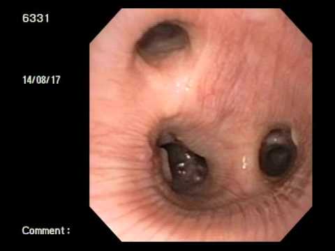 What is chronic bronchiectasis?