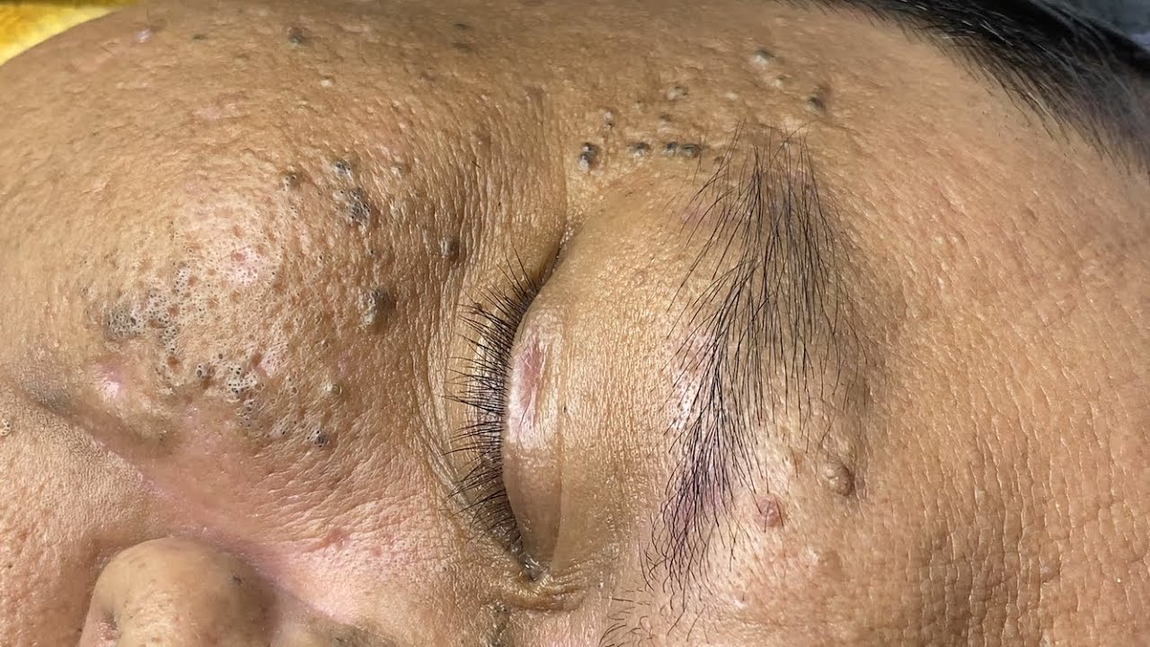 Removing blackheads from an elderly man