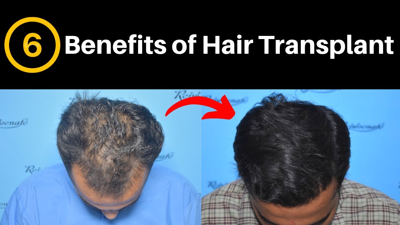 Best Hair Transplant In Hyderabad