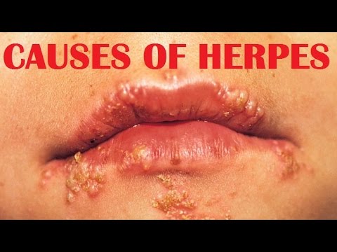 New herpes drugs in the pipeline