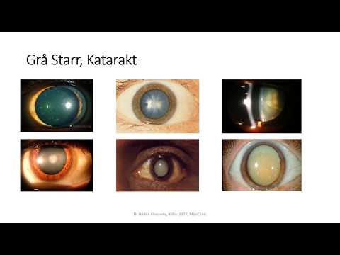 Grå starr, Katarakt, Cataract Dr Joobin Khadamy