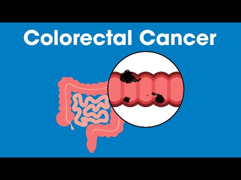 Colorectal Cancer Signs & Screenings | Munson Minutes