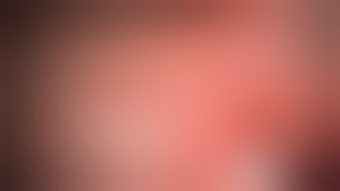 Cholangiocarcinoma - Bismuth Type I