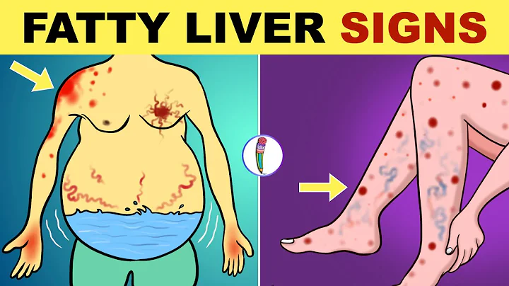 Fatty Liver Symptoms | Early Signs of Fatty Liver Disease | Non Alcoholic Fatty Liver Disease - DayDayNews