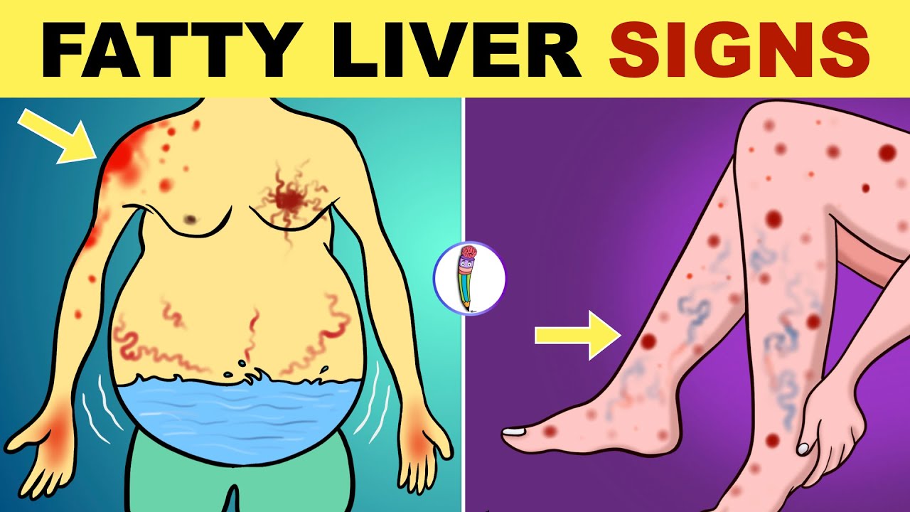 Symptoms of Fatty Liver Disease