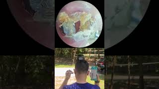 #earwaxremoval #earwax #satisfying #wax #cleaning