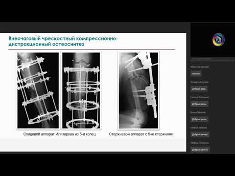 Физиология и патология заживления переломов костей конечностей