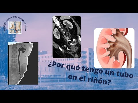 Video: ¿Dónde se colocan las sondas de nefrostomía?