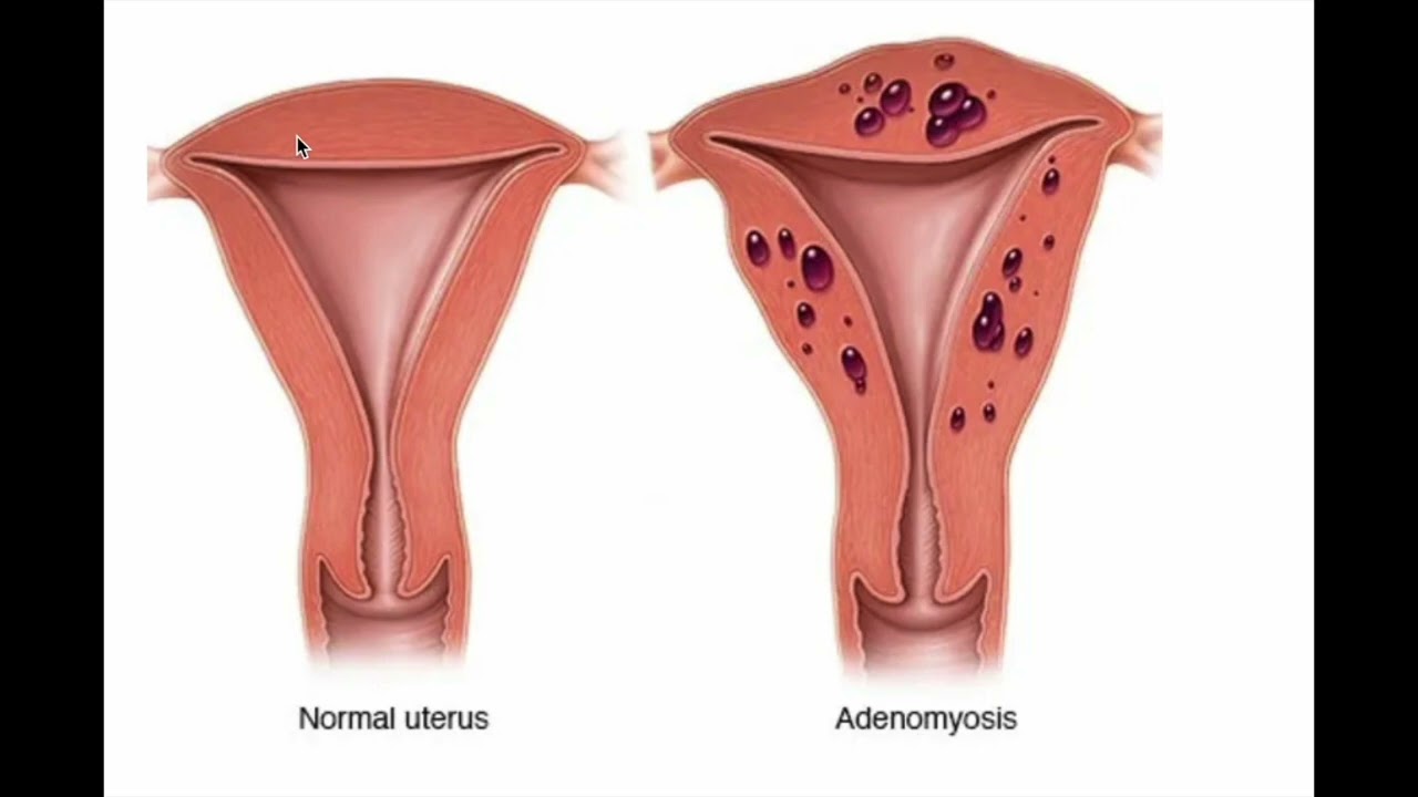 What is Adenomyosis?