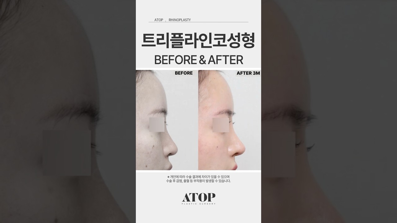 [Эйтоп гоо сайхны мэс заслын эмнэлэг] Трипл Лайн хамарны мэс засал_Сэтгэгдэл 6 #ЭйтопГооСайхныМэсЗаслынЭмнэлэг #ГаннамГооСайхныМэсЗаслынЭмнэлэг #ХамарныМэсЗаслыгСайнХийдэгГазар