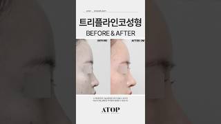 트리플라인코성형_후기6 #에이탑성형외과 #강남성형외과 #코성형잘하는곳