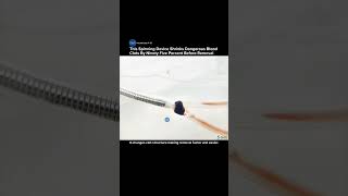 New Spinning Device Removes Deadly Blood Clots in Seconds Without Surgery #stroke #treatment #tech