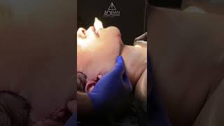 Deep plane face and neck lift - الشد العميق للوجه #تجميل #facelift #faceliftexpert