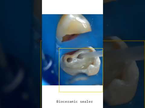 حشوة جذر باستخدام بايسيراميك سيلير          