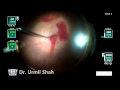 Dr  urmil shah 25g vitrectomy