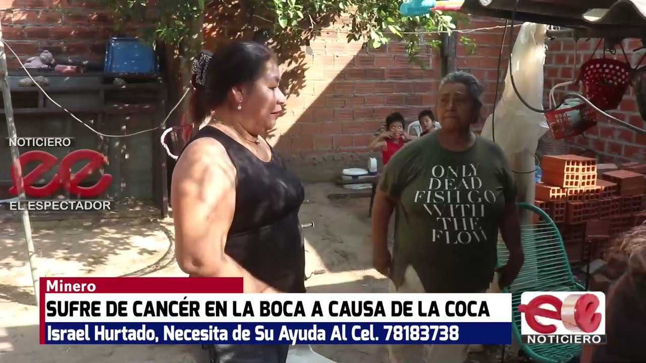 EN MONTERO, UN JOVEN SUFRE DE CANCER EN LA BOCA POR EL ALTO CONSUMO DE COCA, Bolivia.