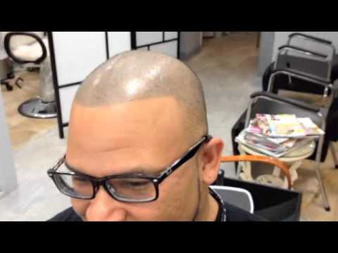 Video thumbnail: Update Mr JJ Scalp Pigmentation | Hair transplant African American