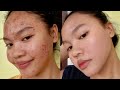 How I cleared my  Acne prone skin?| Sensitive,Acne prone