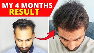 2500 Grafts, 4 Months Later 4 Months After Hair Transplant Result
