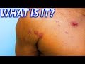Bigfoot's Real Chest - Pimples, Acne or Pox?
