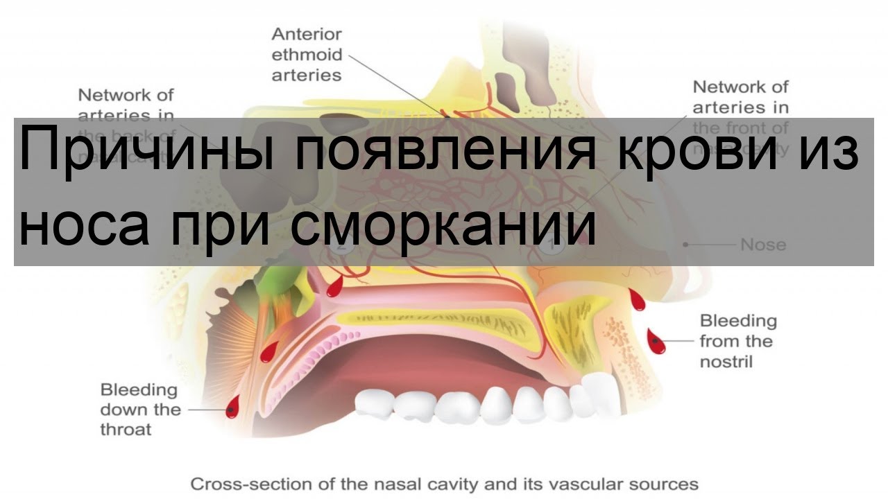 Почему чихаю кровью