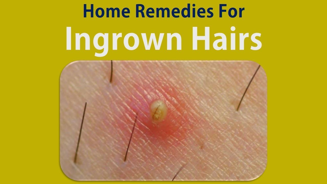 Home Remedies For Ingrown Hairs Stop Ingrown Hairs With Honey