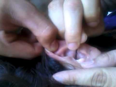 Play Ear Wax Removal Videos 86